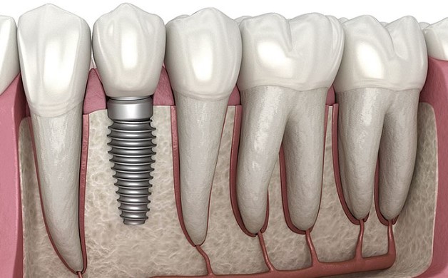 Restoring Smiles: The Comprehensive Guide to Dental Implants